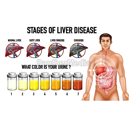 Etapas De La Enfermedad Hep Tica Stockphoto Agencia De